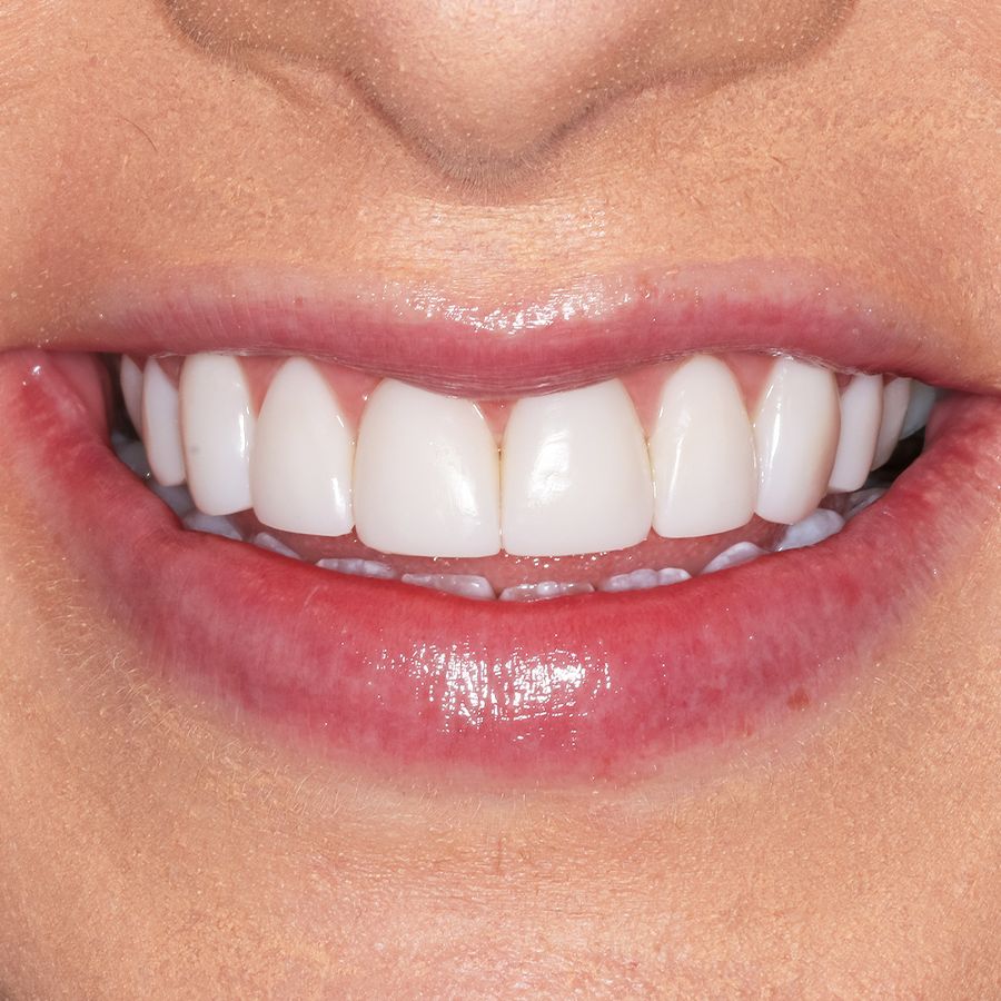 composite veneers smile 5